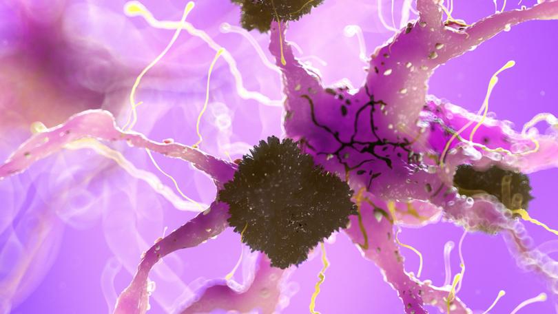 3d rendered medically accurate illustration of amyloid plaques on a nerve cell - alzheimer disease