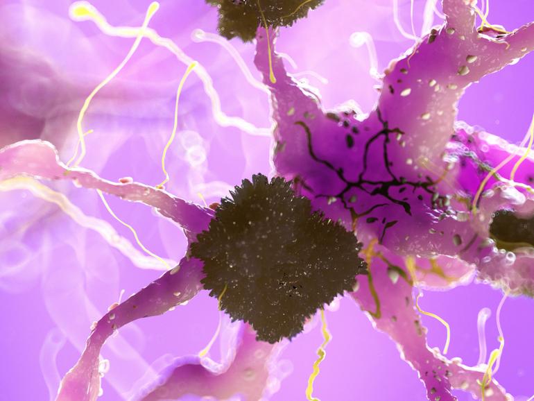 3d rendered medically accurate illustration of amyloid plaques on a nerve cell - alzheimer disease
