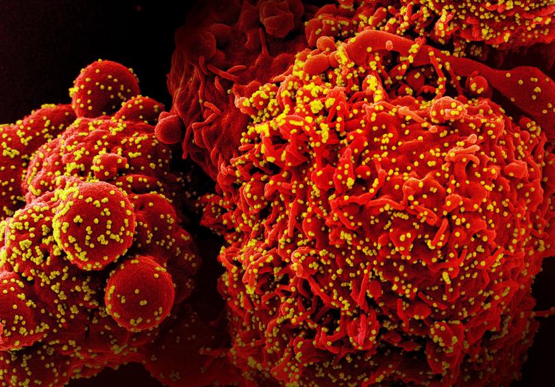  EMBARGO: NO ELECTRONIC DISTRIBUTION, WEB POSTING OR STREET SALES BEFORE 3:01 A.M. ET ON TUESDAY, NOV. 21, 2023. NO EXCEPTIONS FOR ANY REASONS   An image provided by the National Institute of Allergy and Infectious Diseases shows a colorized scanning electron micrograph of a cell (red) infected with Omicron virus particles, yellow. The dominant variant of the coronavirus has proved to be not only staggeringly infectious, but an evolutionary marvel.  (NIAID via The New York Times)  NO SALES; EDITORIAL USE ONLY