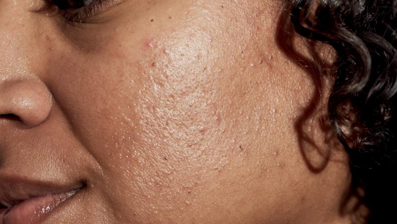 Dermatologists say that it’s common to get acne in your 30s, 40s and beyond — even if you never had breakouts as a teen. 