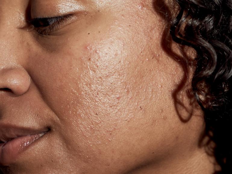 Dermatologists say that it’s common to get acne in your 30s, 40s and beyond — even if you never had breakouts as a teen. 