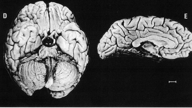 Taken in 1955, this photo shows five views of Albert Einstein's brain with meninges removed. 