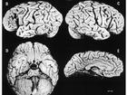 Taken in 1955, this photo shows five views of Albert Einstein's brain with meninges removed. 