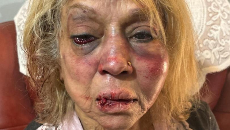 Ninette Simons received severe facial bruising and swelling after she was allegedly assaulted during a shocking home invasion at her Girrawheen home. WA Police/Supplied