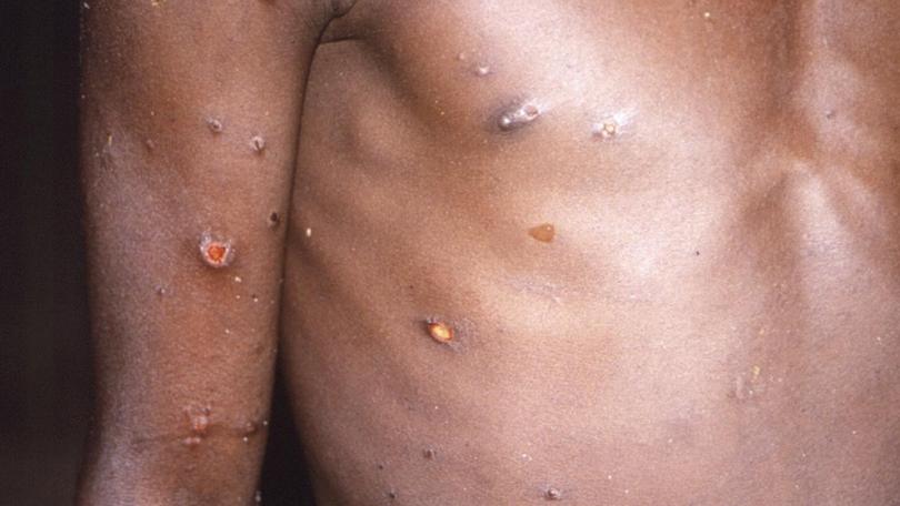 Monkeypox spreads via close physical contact and while most cases are mild, the infection can kill. (AP PHOTO)