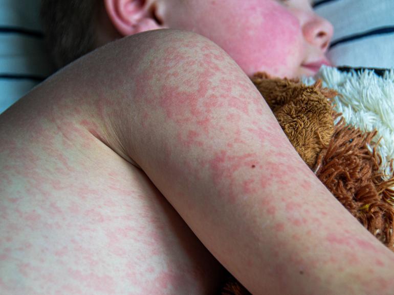 A number of measles exposure sites have been identified in Adelaide. File image.