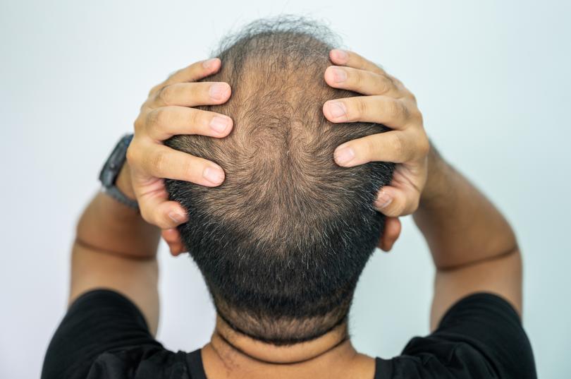 Up to half of men will experience some form of male-pattern baldness by 50.