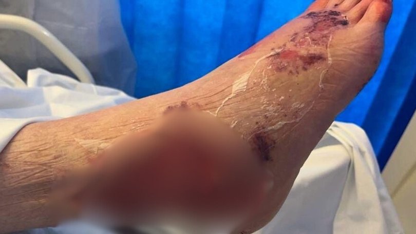 Surgeons fought to cut away the bug by removing the infected tissue.