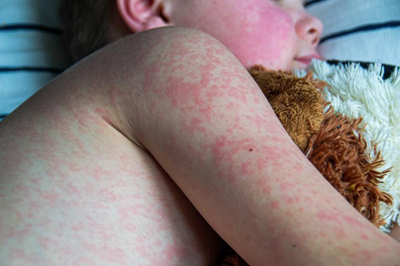 A rash will start to develop about three to five days after a person is infected with measles.