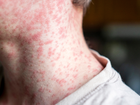 An overseas traveller infected with measles who returned to Victoria has sparked an urgent warning from the state’s  health department.