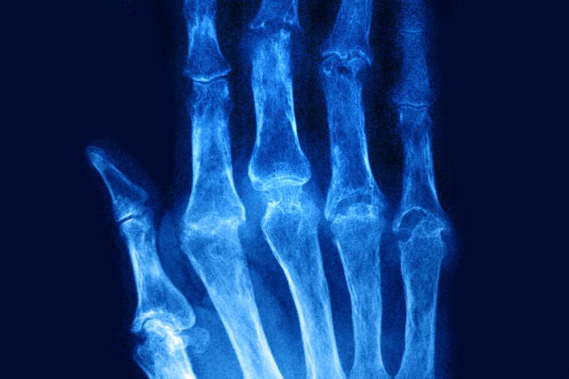 Rheumatoid arthritis seen on an X-ray of the hand.  It causes inflammation in the body and commonly presents with pain in the joints.