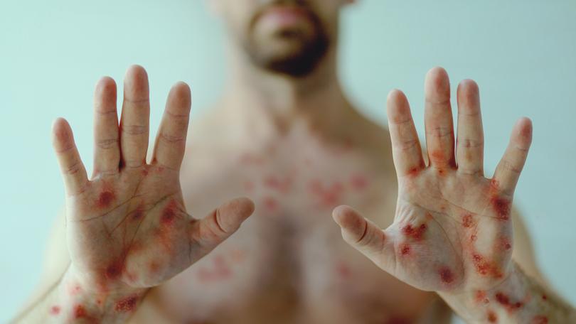 a Male hands affected by blistering rash because of monkeypox or other viral infection on green background