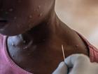 Mpox has been a health issue in Africa since 1970 but received little attention until a 2022 surge. (EPA PHOTO)