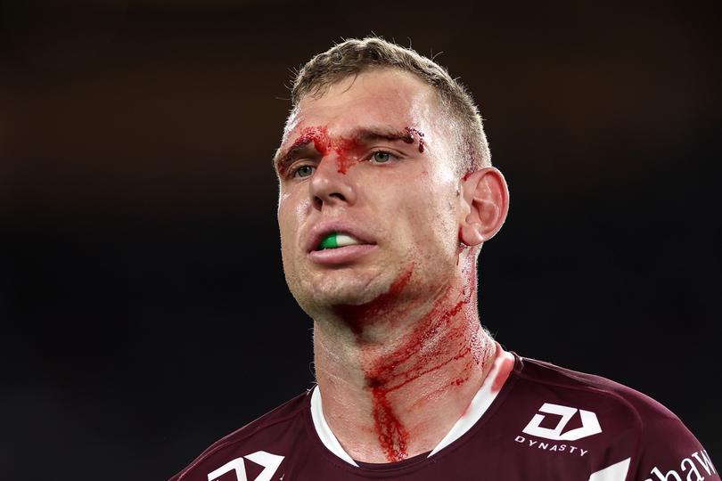 SYDNEY, AUSTRALIA - AUGUST 30:  Tom Trbojevic of the Sea Eagles is assisted by a trainer after an injury and a head cut during the round 26 NRL match between Canterbury Bulldogs and Manly Sea Eagles at Accor Stadium on August 30, 2024, in Sydney, Australia. (Photo by Cameron Spencer/Getty Images)