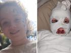 Queensland girl Daniella Jacobs-Herd suffered serious burns when the polyester hooded gown she was wearing caught fire.