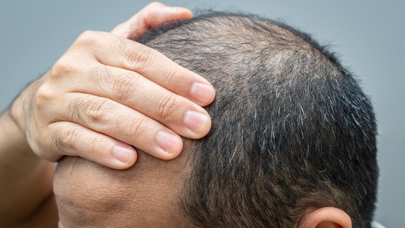 Here are some of the promising new baldness cures being developed.