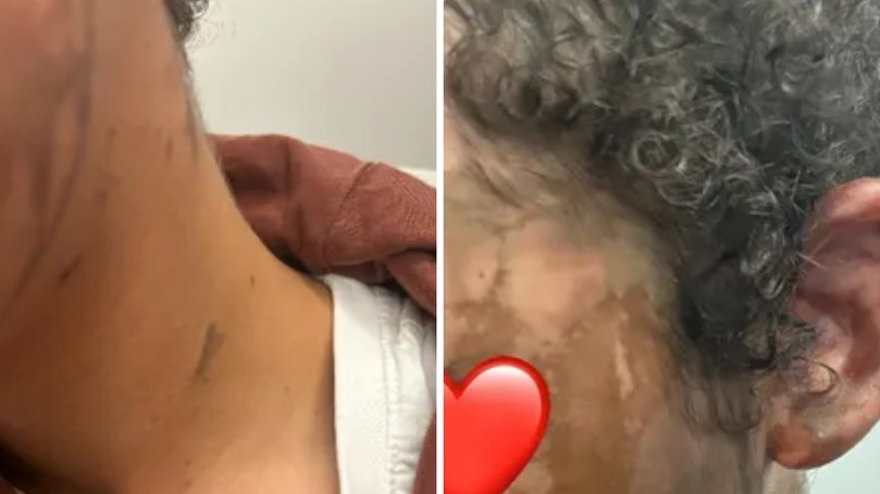 Teagan McFarlane sustained 'potentially life-changing' injuries after she was doused in acid by a stranger outside her school.