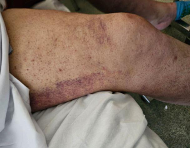 The legs of the scurvy patient at Sir Charles Gairdner Hospital show a nasty rash, one of the signs of the old condition.