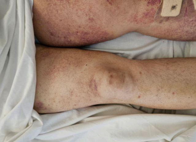 The legs of the scurvy patient at Sir Charles Gairdner Hospital show a nasty rash, one of the signs of the old condition.