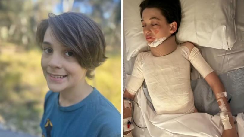 Levi Presland, 12, suffered serious burns and undergone eight surgeries after his polyester jumper caught fire.