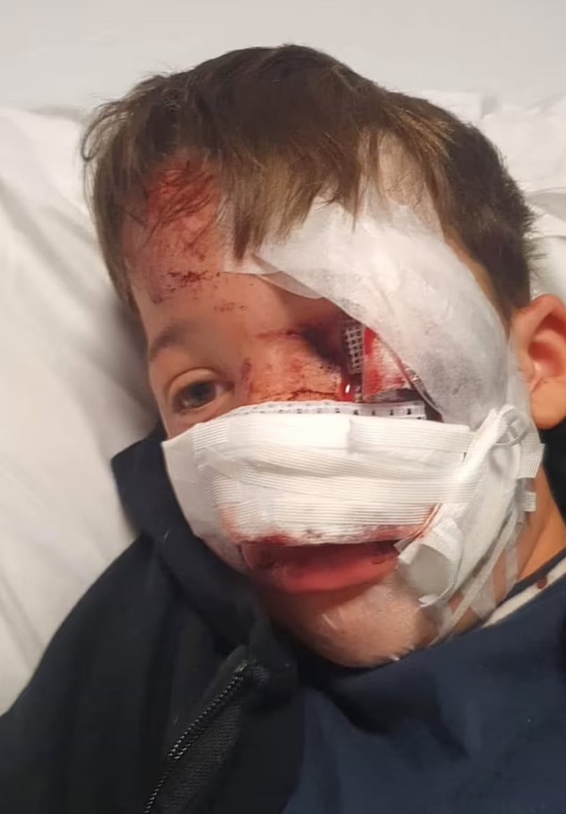 Carter Ralph was left with his nose hanging off when he was struck while playing outside his home.