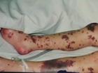 An example of the type of rash that can be experienced by meningococcal sufferers. File image