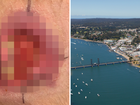 Two confirmed cases have been found in Batemans Bay on NSW’s south coast.
