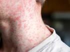 A confirmed measles case has visited multiple locations across NSW while infectious, sparking an alert. 
