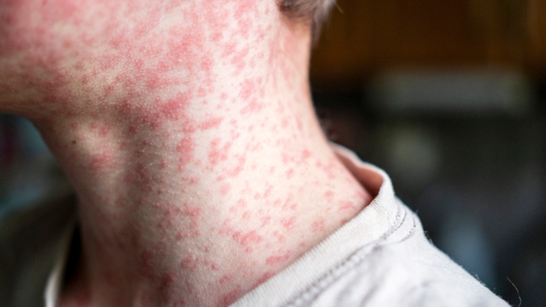 South Australia has reported its first case of measles in 2025, as Victoria battles its own outbreak and both states issue alerts.