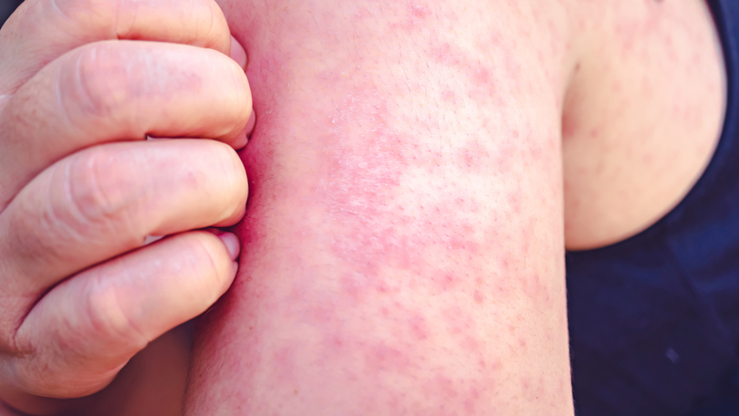 Two measles alerts have been issued for Western Sydney and the Gold Coast on the same day.