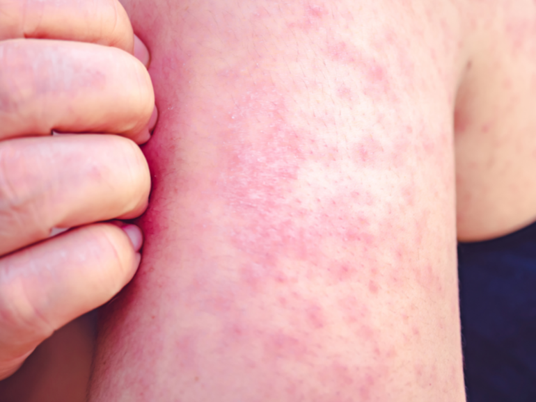 Two measles alerts have been issued for Western Sydney and the Gold Coast on the same day.