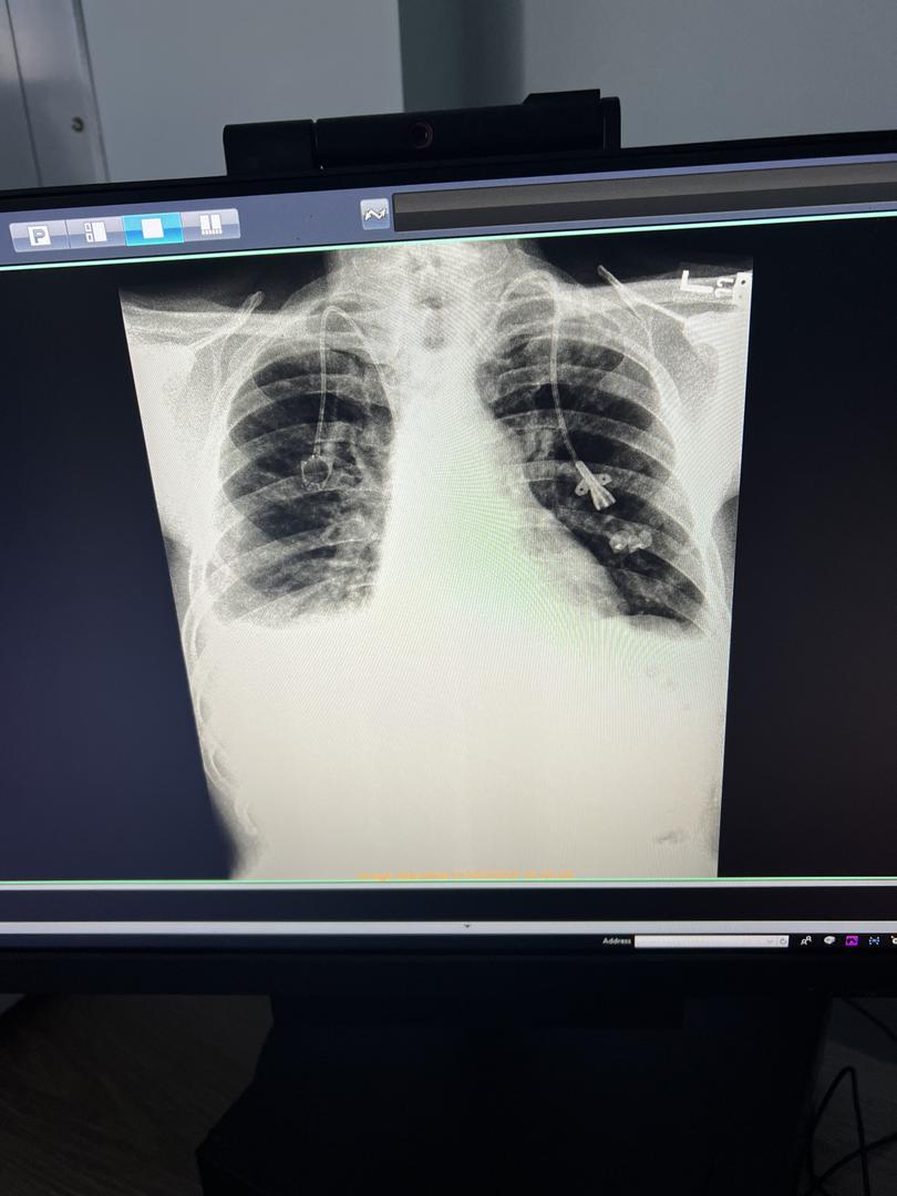 In an image provided by his wife, a scan of the lungs of David Hudlow who was stricken with esophageal cancer. 