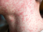 Health authorities in Victoria and New South Wales have issued fresh measles alerts following multiple confirmed cases in both states, some linked to recent travel from Bali.