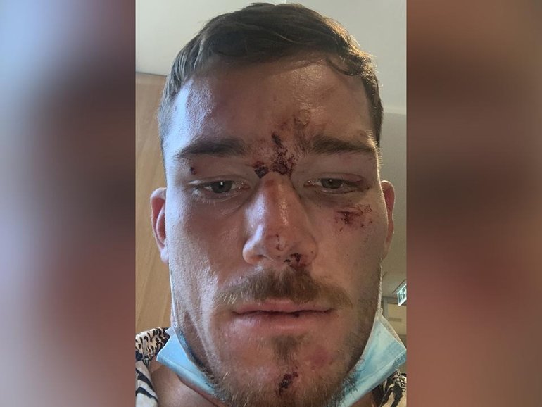 Two police officers are fighting charges they assaulted Tom Starling during a 21st birthday party. (HANDOUT/Tom Starling)