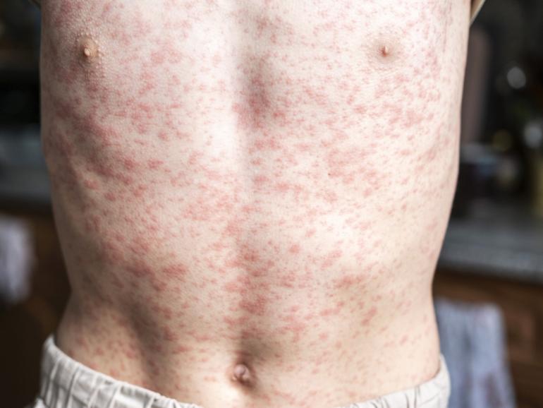 Victoria sees worst measles outbreak in a decade.