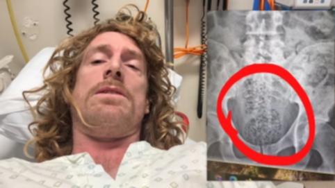 Michael Brookhouse had an X-ray which revealed a huge amount of whole coffee beans in his digestive tract.