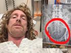 Michael Brookhouse had an X-ray which revealed a huge amount of whole coffee beans in his digestive tract. 