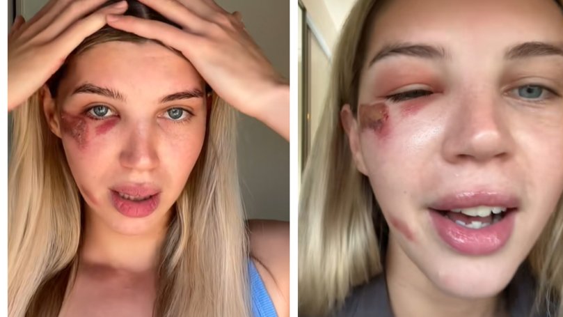 Dr Murphy shows her injury healing over the next few days, though her eye swelling increases.
