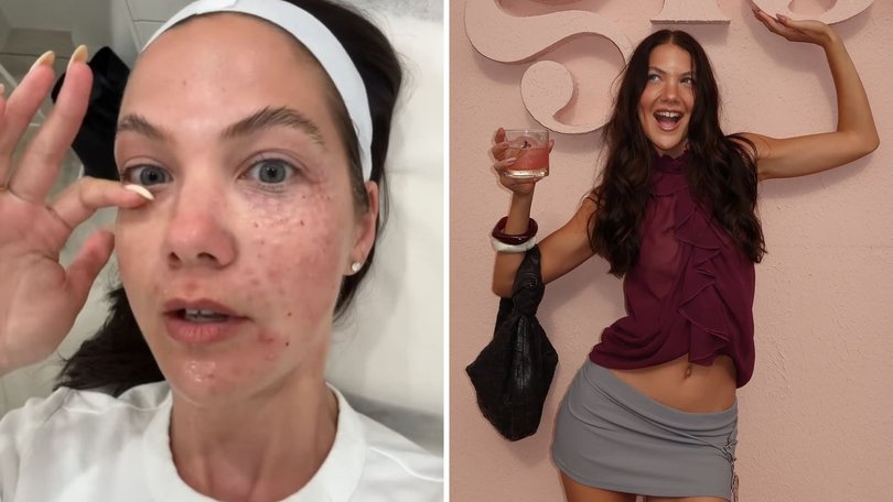 Perth influencer Jacquie Alexander has documented her first time getting a salmon sperm facial and hoped rejuvenating results made the painful experience worth it.