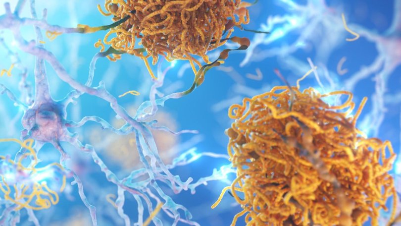 The TGA has approved a new drug that will slow cognitive decline in people suffering from early stage Alzheimer’s. Supplied