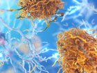 The TGA has approved a new drug that will slow cognitive decline in people suffering from early stage Alzheimer’s. Supplied