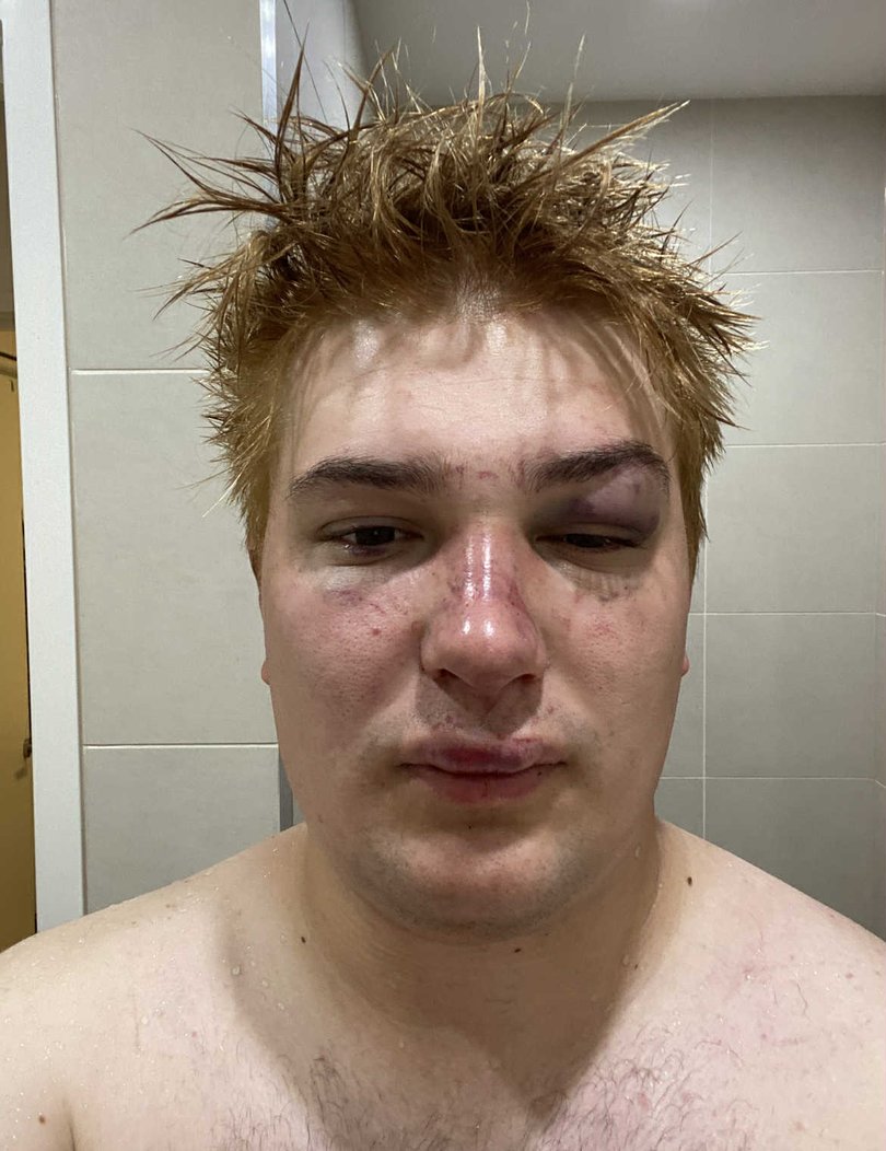 Jack Jacobs has spoken about being viciously gay bashed in Melbourne in 2020.