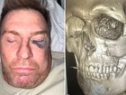 Gary Moorcroft requires facial surgery after an accident at home.