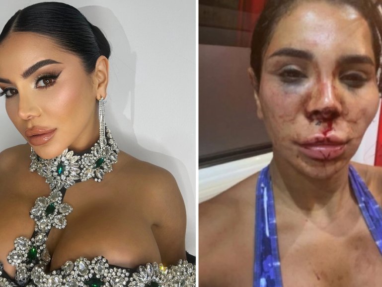 Soraya Riffy, 30, after being allegedly assaulted by three men.