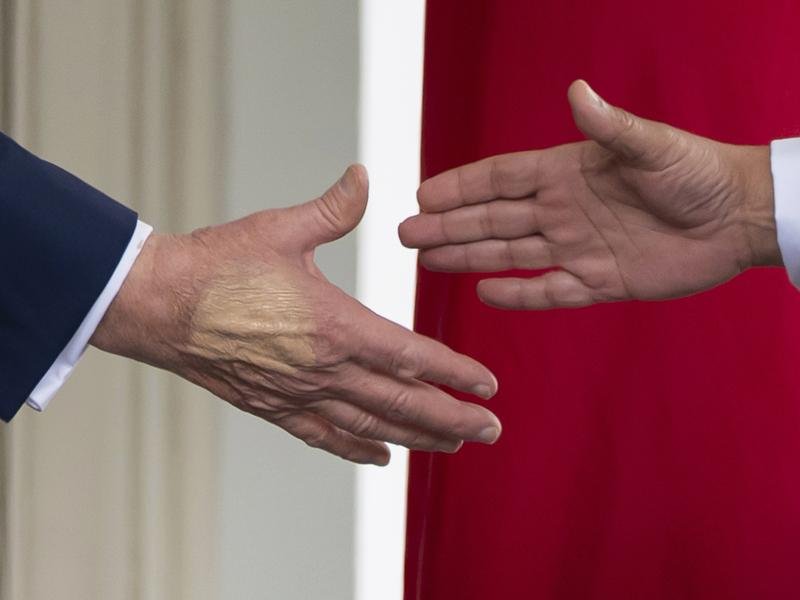 US President Donald Trump has bruising on his hand caused by frequent hand shaking. (AP PHOTO)
