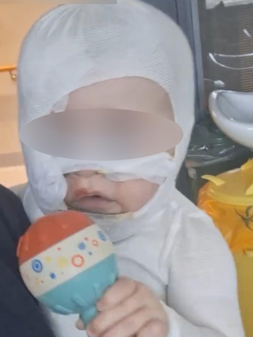 Baby Luka suffered burns to his face and chest after hot coffee was poured on him. Picture: Supplied.