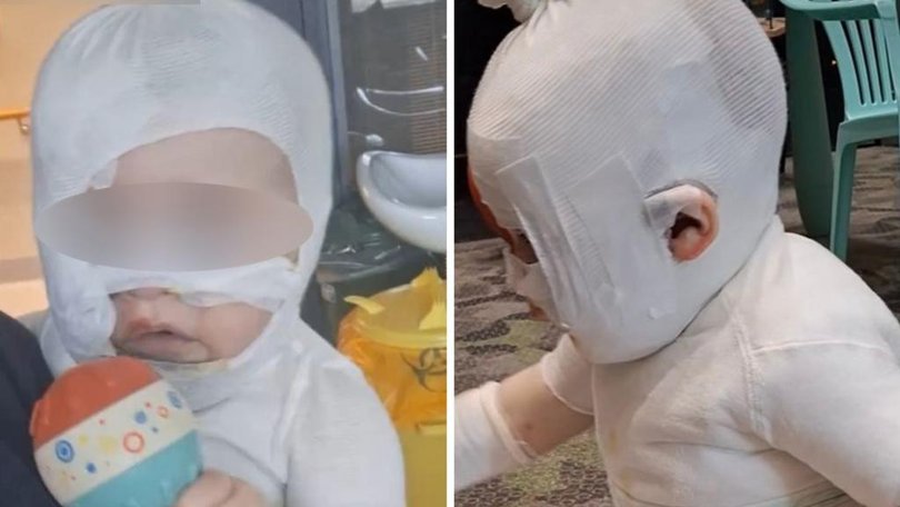 A mother has spoken out nearly a year after hot coffee was poured on her baby.