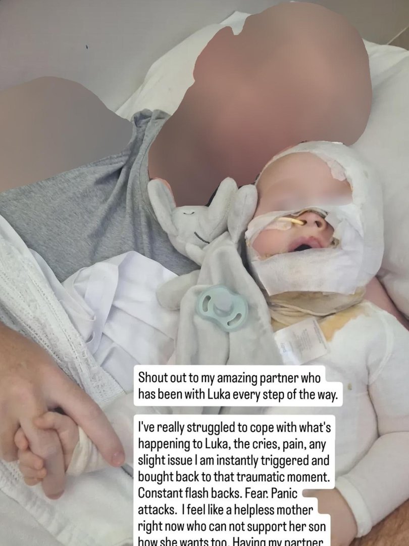 Luka had to undergo eight surgeries and received skin grafts following the attack. Picture: Supplied.