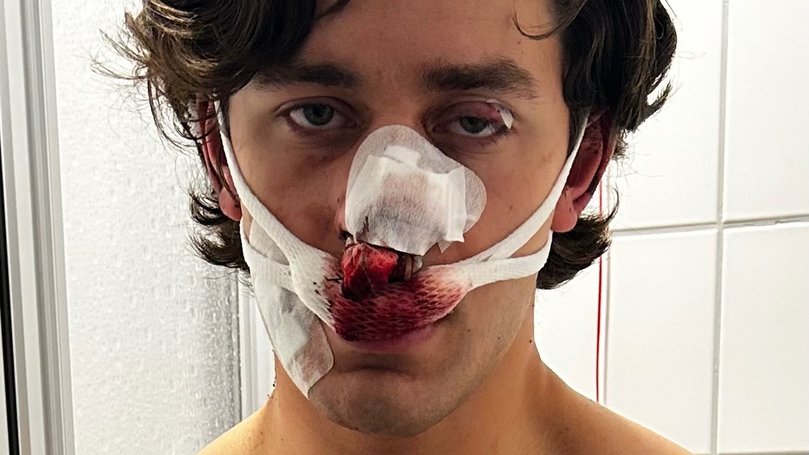 Mr Rudat suffered injuries to his face after saving two women from being attacked in Germany.