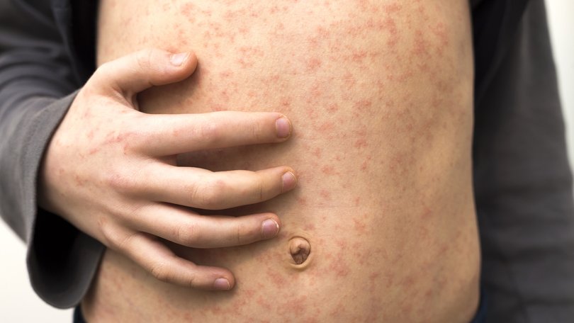 Urgent warning issued after outbreak across Queensland.